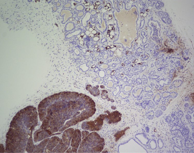 Imatge d'immunohistoquística del FASN en una mama de ratolí transgènic que desenvolupa tumors de mama